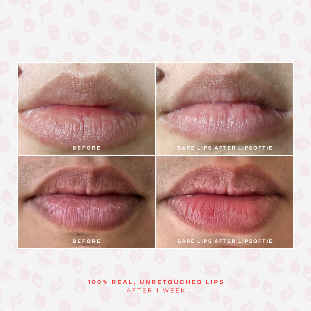 SOS LipSoftie® Lip Treatment